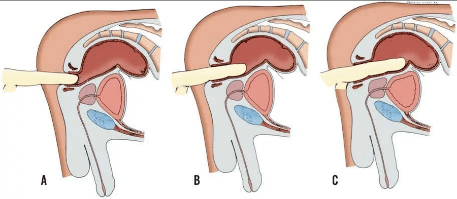Rectal examination of the fingers